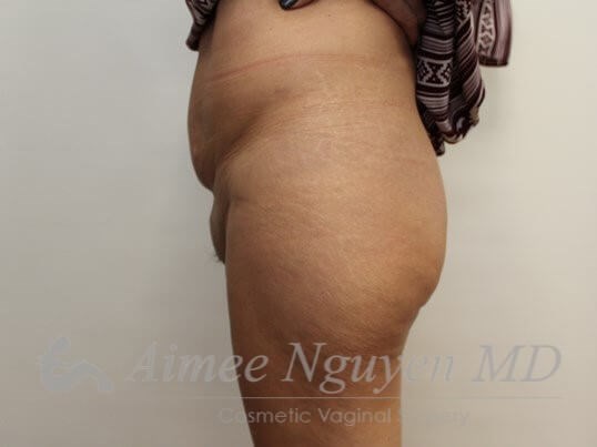 Pubic lift & Liposuction Before
