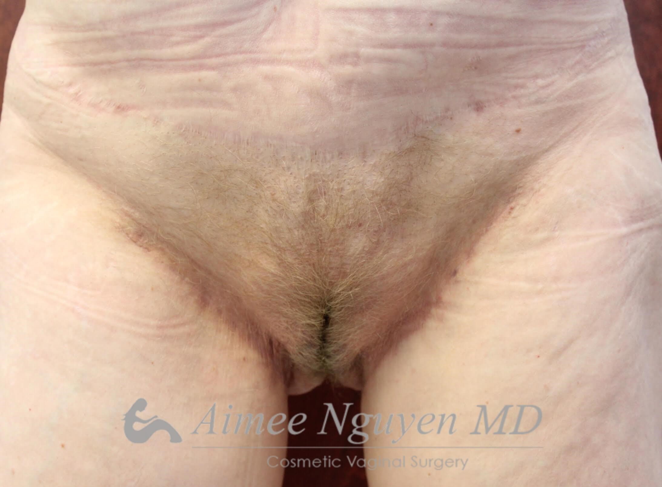 Pubic Liposuction After
