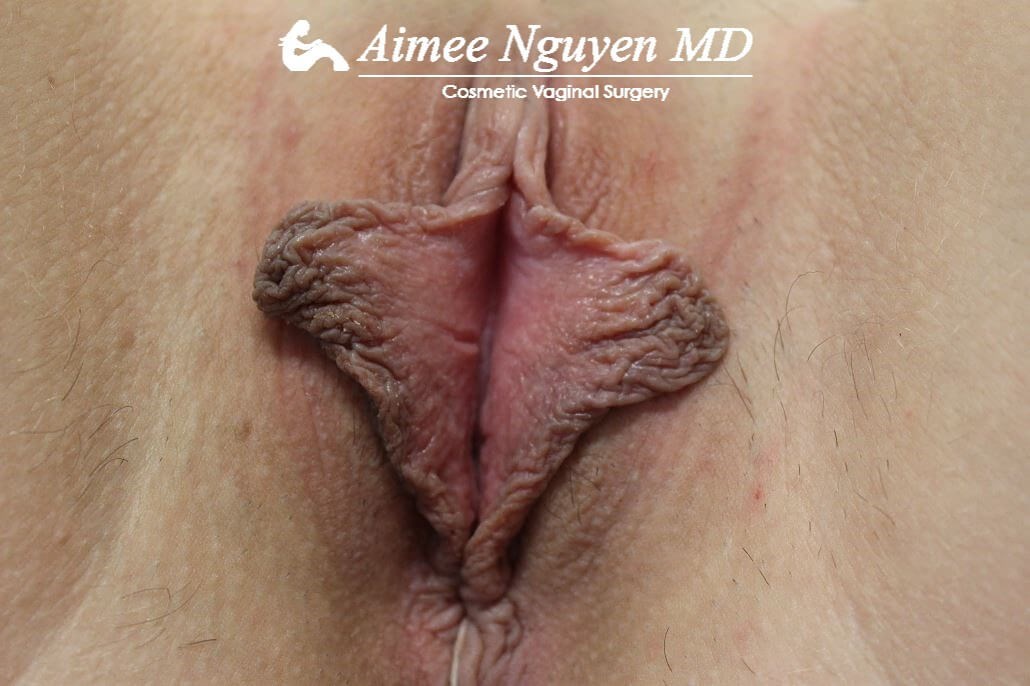 Labiaplasty Minora Before