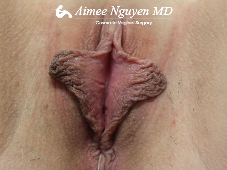 Labiaplasty Minora Before