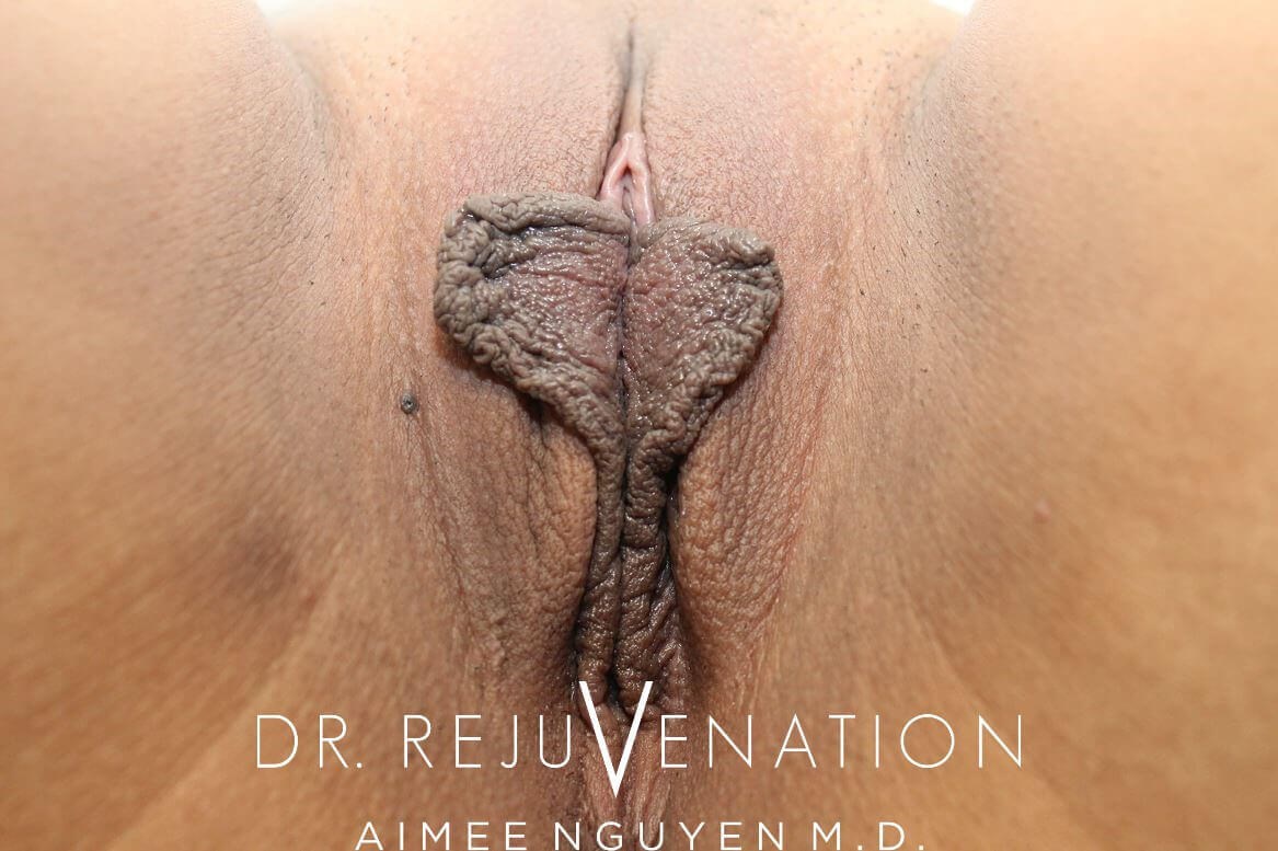 Labiaplasty Minora Before