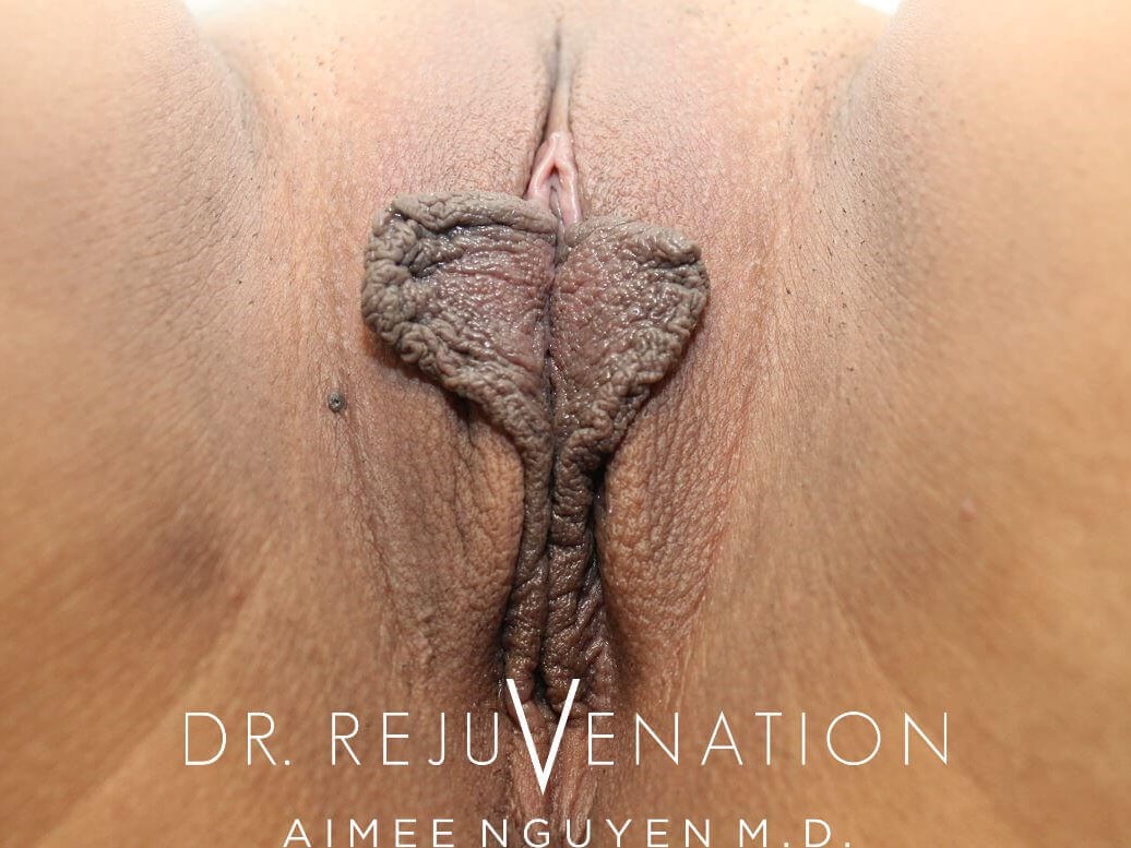 Labiaplasty Minora Before