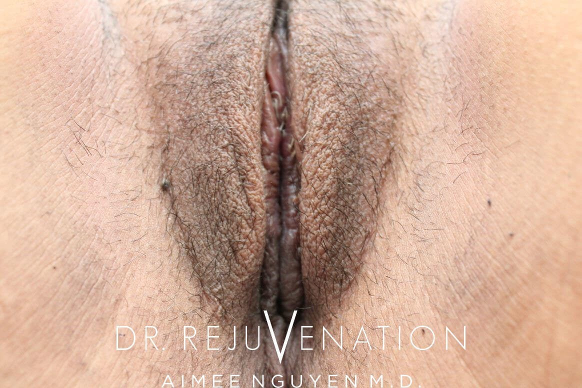 Labiaplasty Minora After