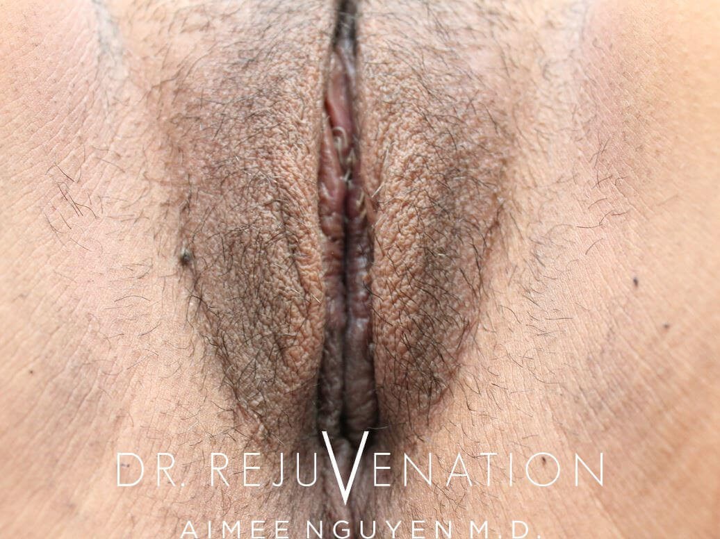 Labiaplasty Minora After