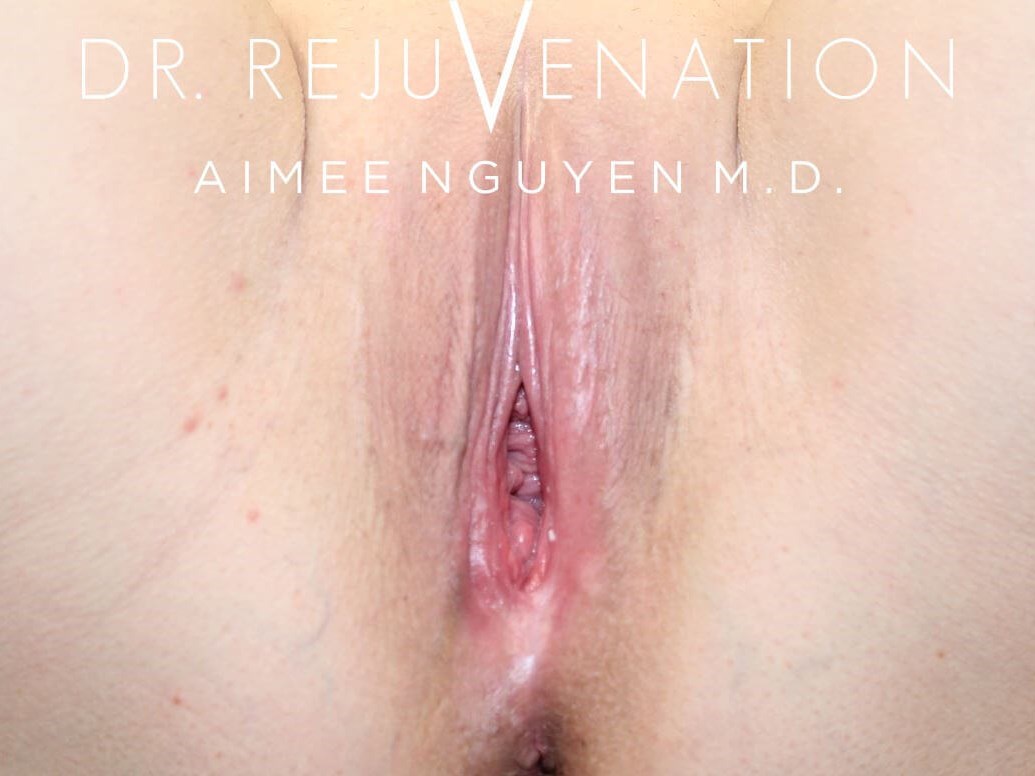 Vagioplasty Revision Before