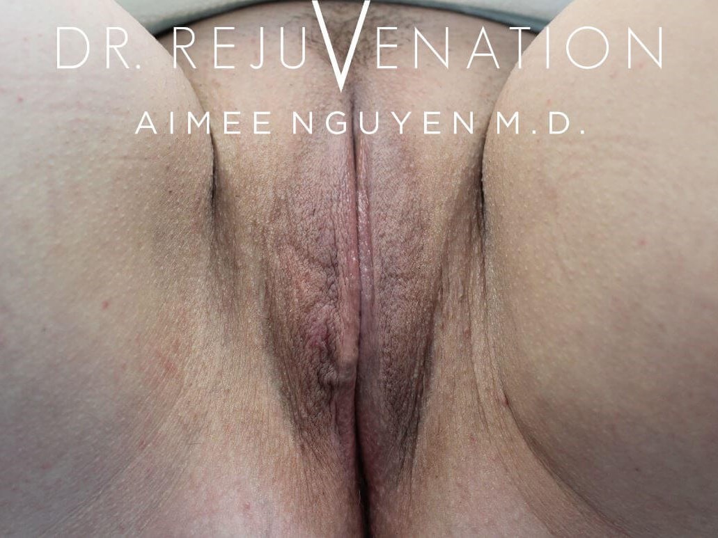 Vagioplasty Revision After