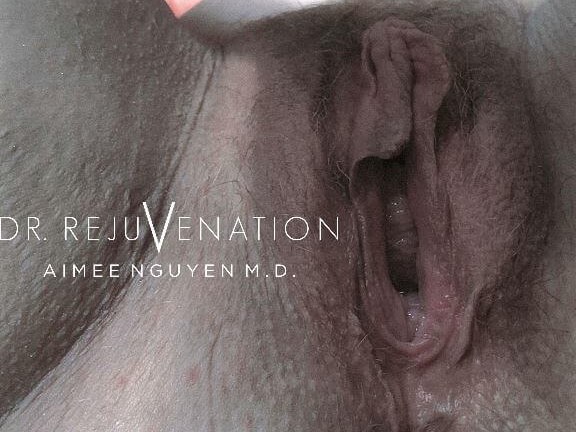 Labiaplasty, Vagioplasty Before