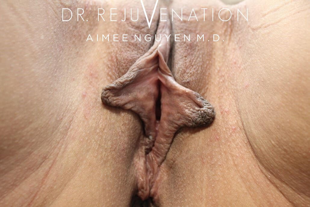 Labiaplasty, Vagioplasty Before