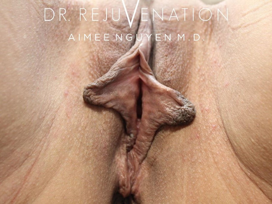 Labiaplasty, Vagioplasty Before