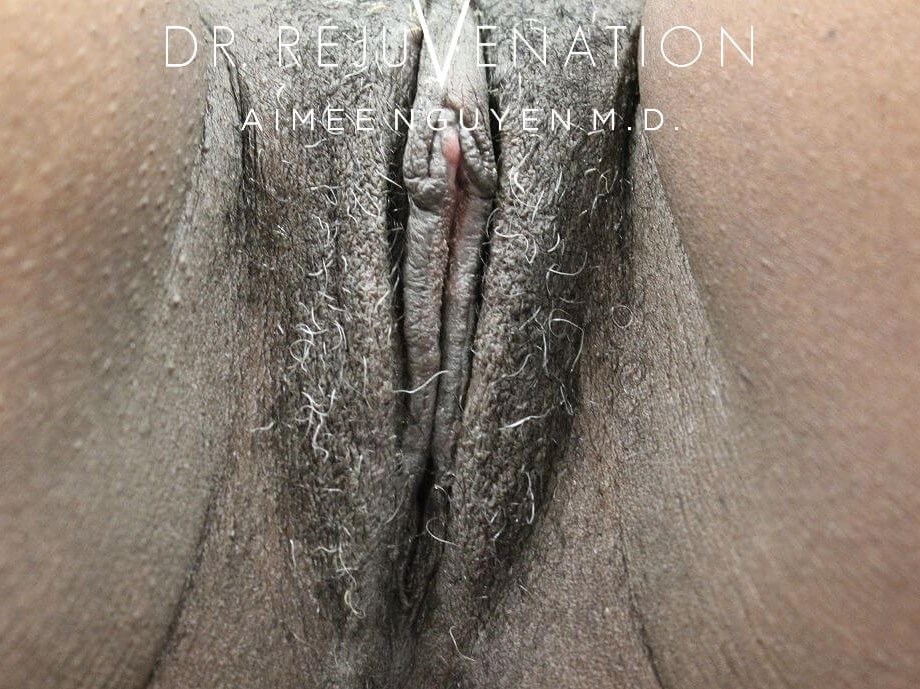 Labiaplasty, Clitoral Hood After