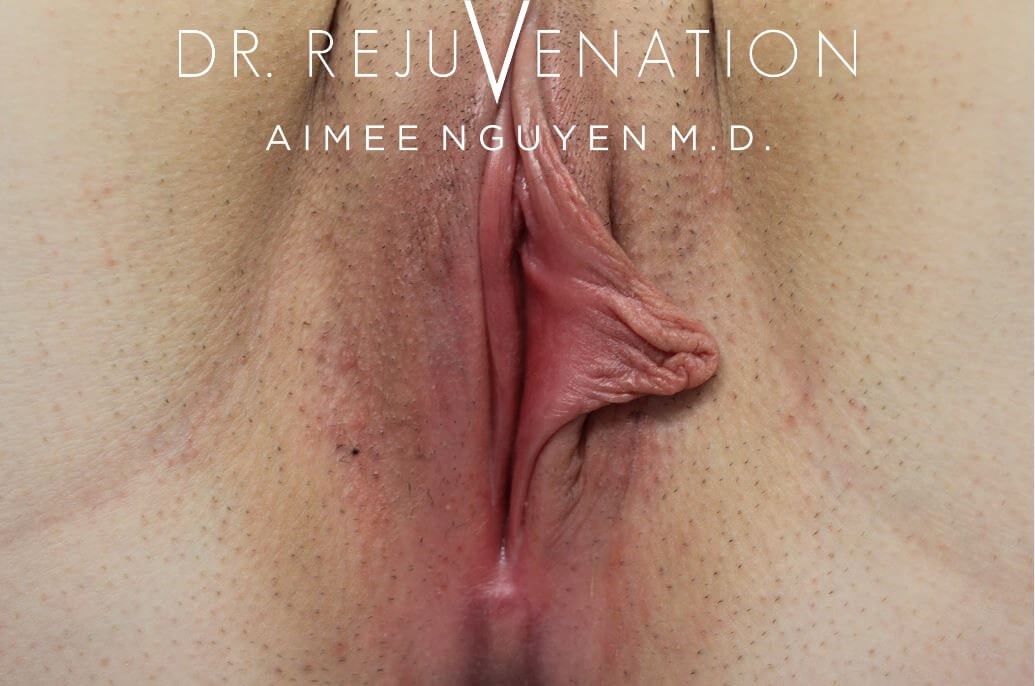 Left Labiaplasty Minora Before