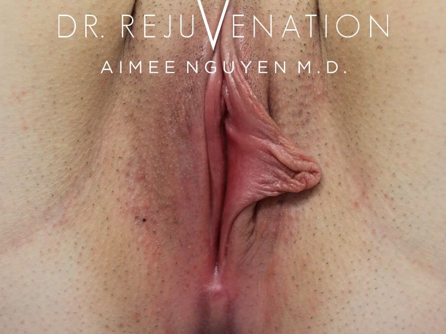 Left Labiaplasty Minora Before