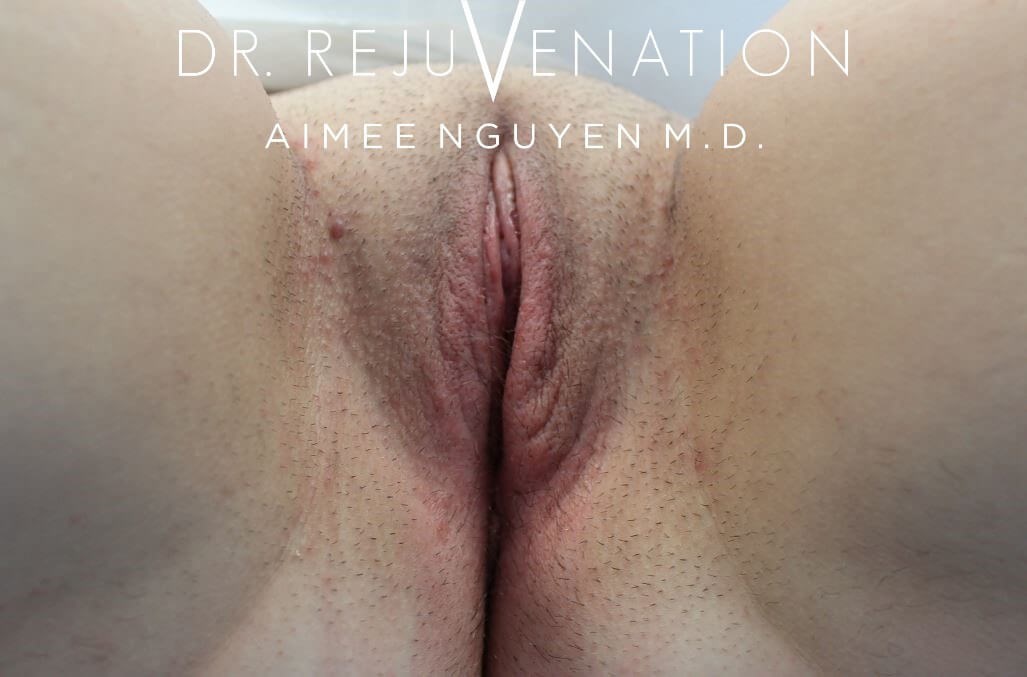Left Labiaplasty Minora After