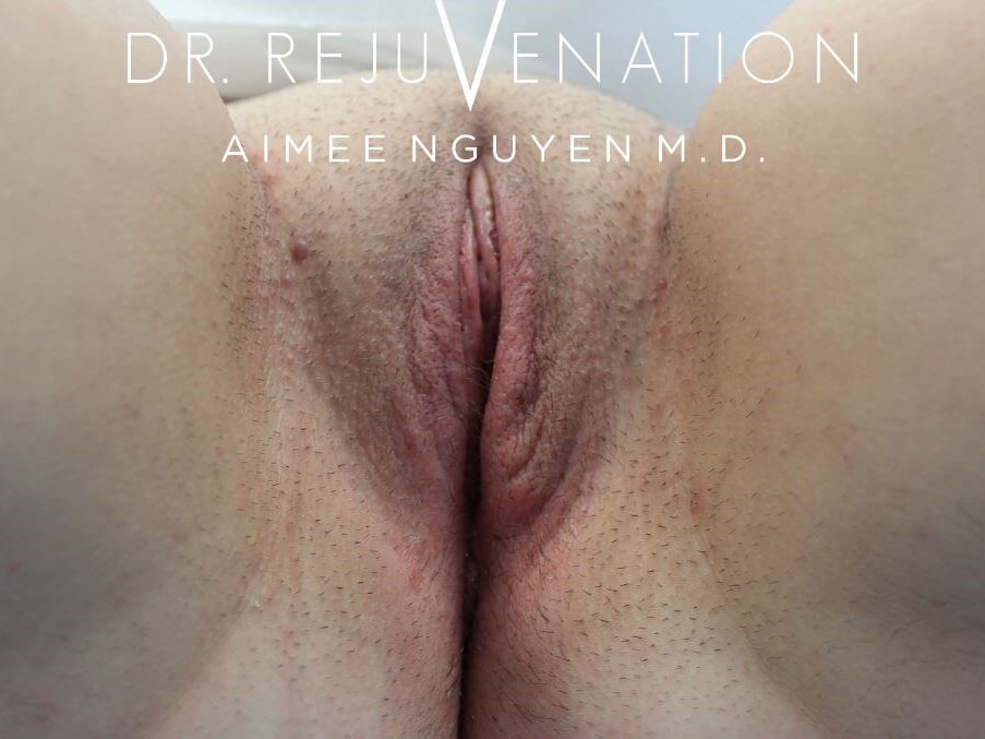 Left Labiaplasty Minora After