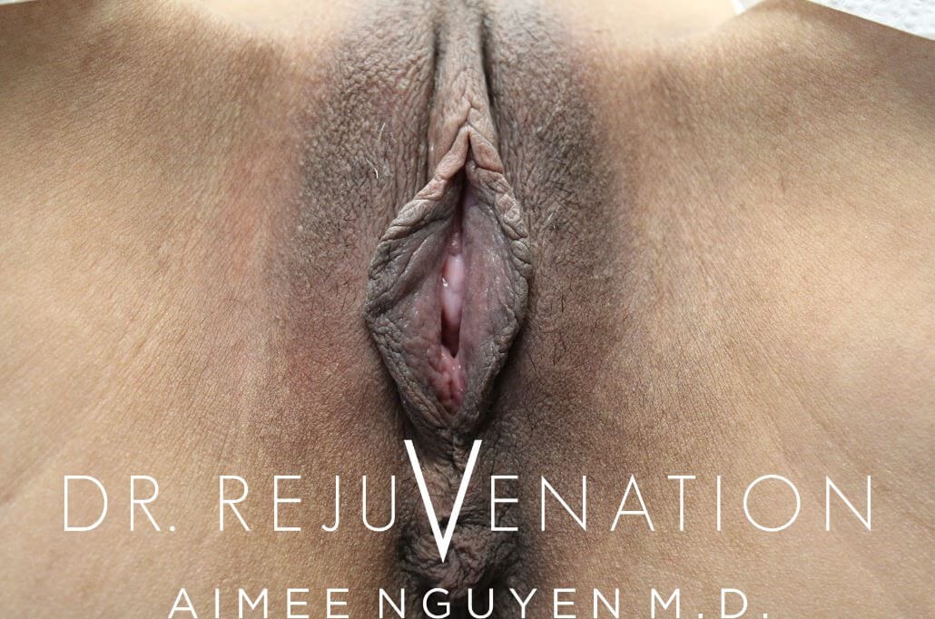 Vaginoplasty, Labiaplasty Before