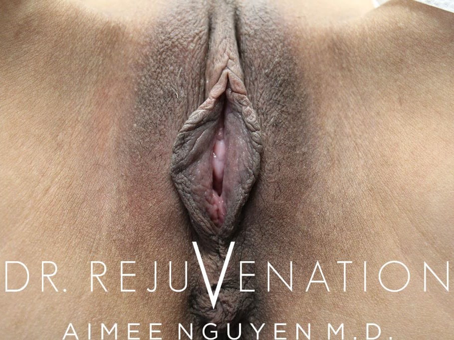 Vaginoplasty, Labiaplasty Before