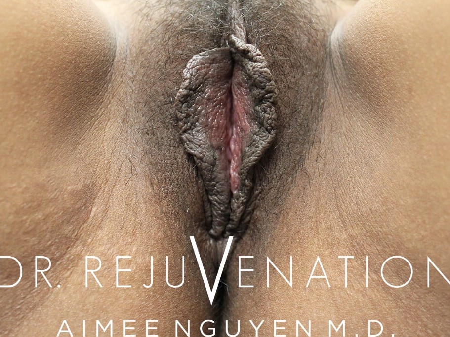 Labiaplasty, Rejuvenation Shot Before