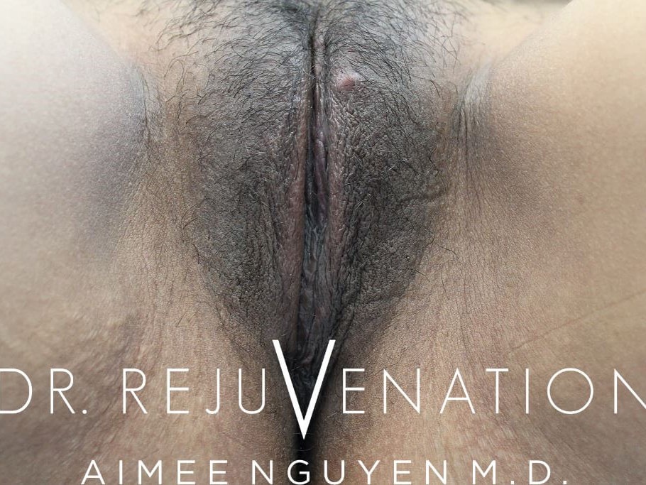 Labiaplasty, Rejuvenation Shot After