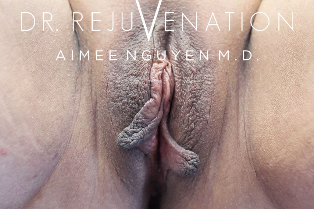 Labiaplasty Minora Before