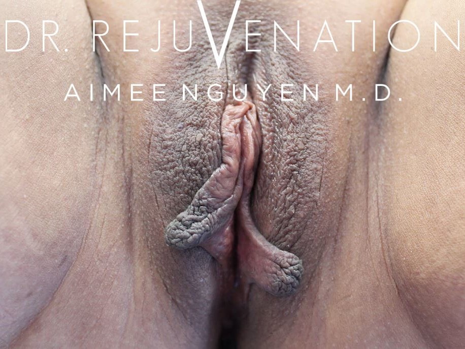 Labiaplasty Minora Before