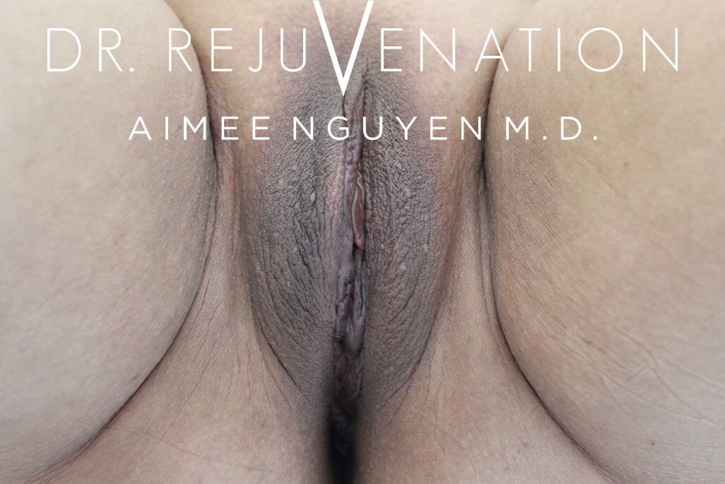 Labiaplasty Minora After