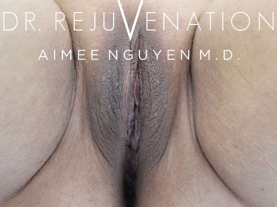 Labiaplasty Minora After