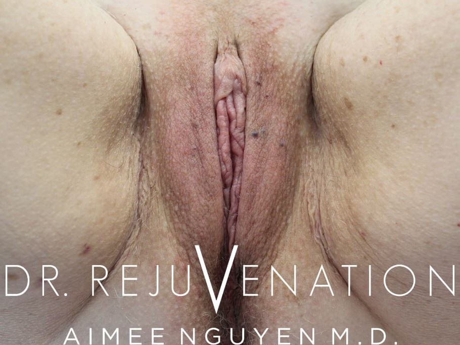 Vaginoplasty, Labiaplasty After