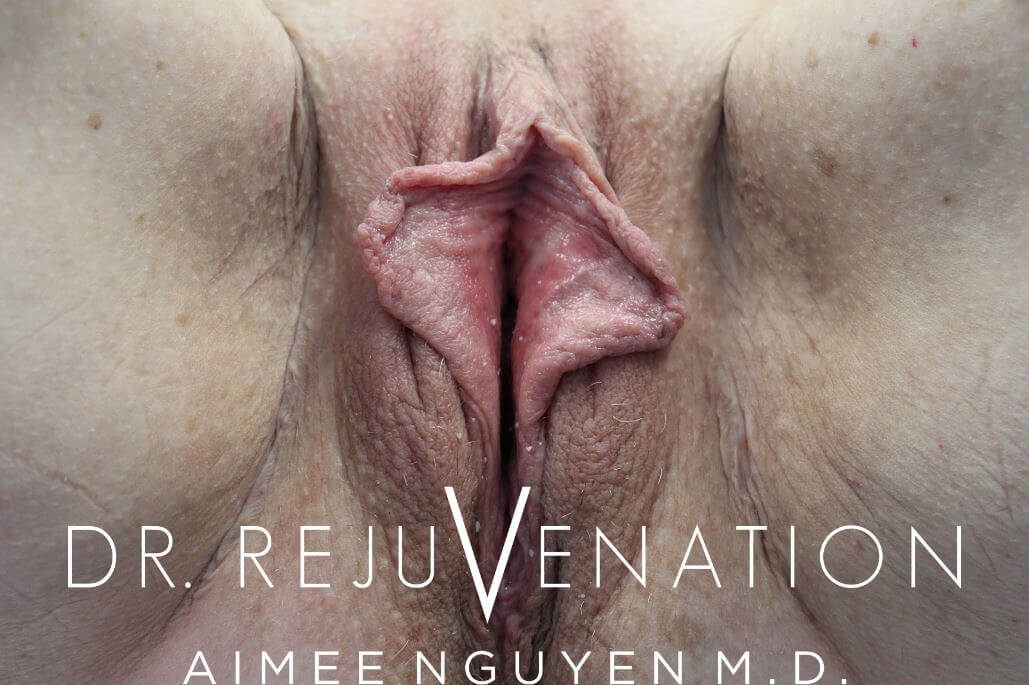 Vaginoplasty, Labiaplasty Before