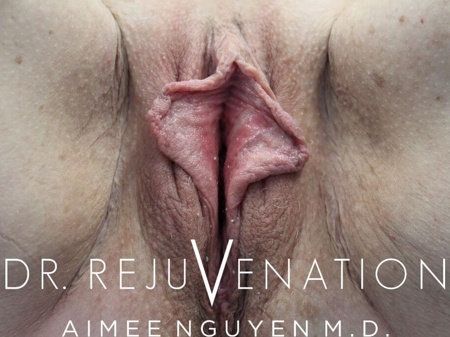 Vaginoplasty, Labiaplasty Before