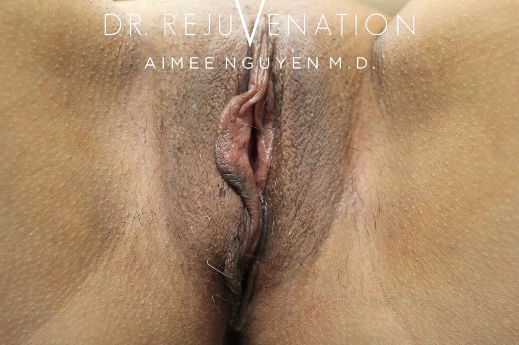Right Labiaplasty Minora Before