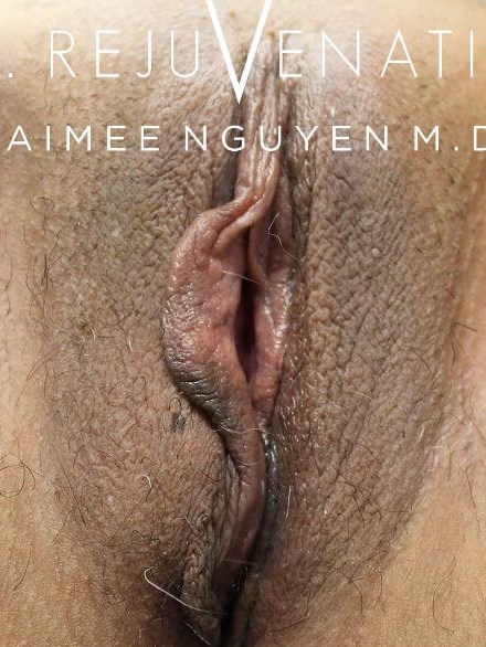 Right Labiaplasty Minora Before
