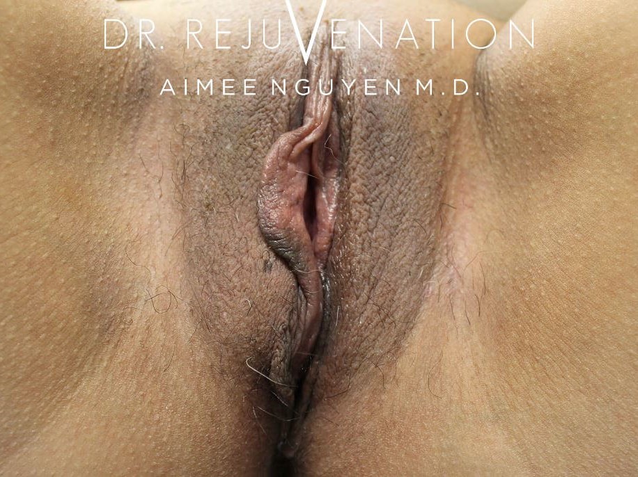 Right Labiaplasty Minora Before
