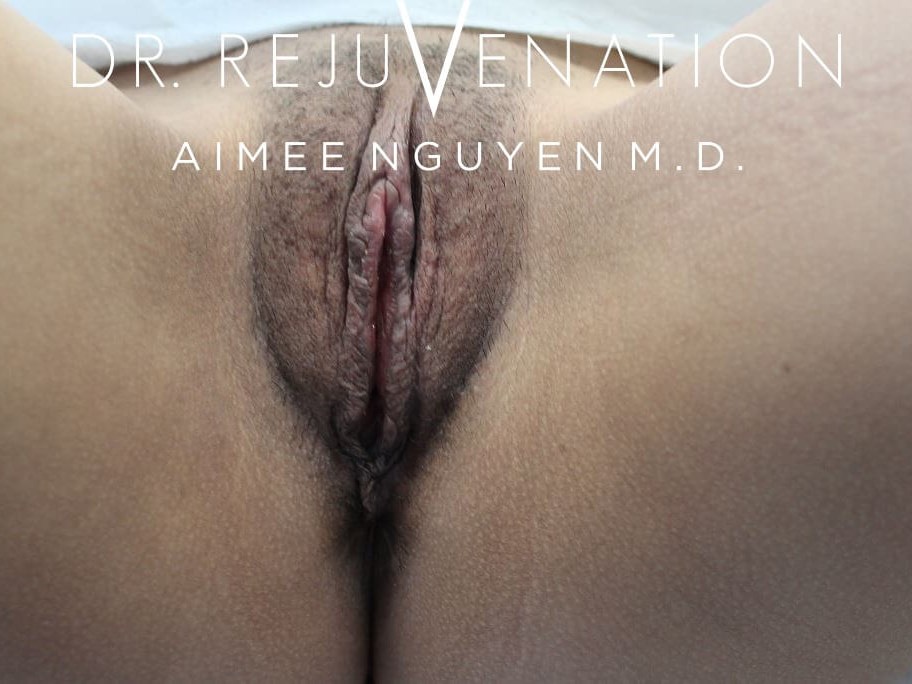Labiaplasty Minora After