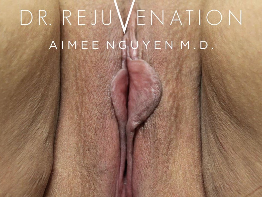 Vaginoplasty, Labiaplasty Before