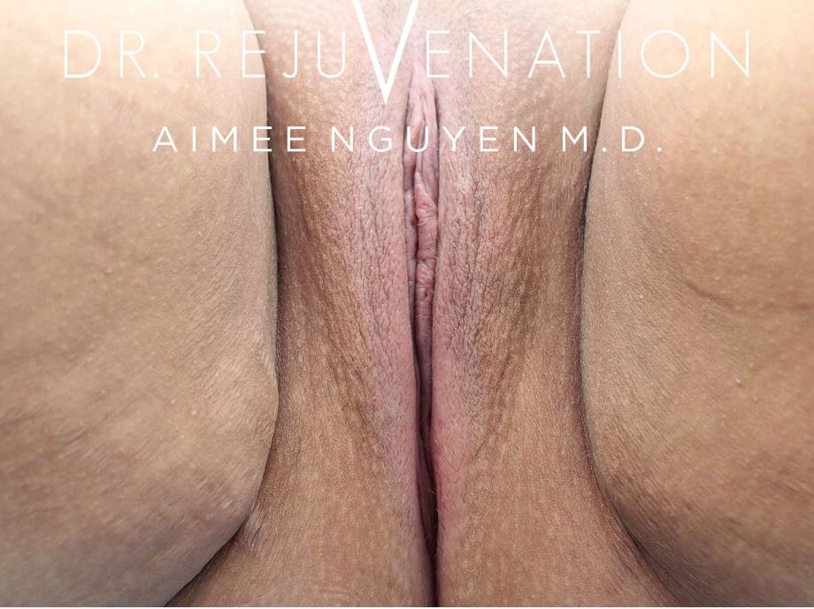 Vaginoplasty, Labiaplasty After