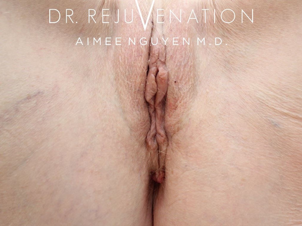Vaginoplasty After