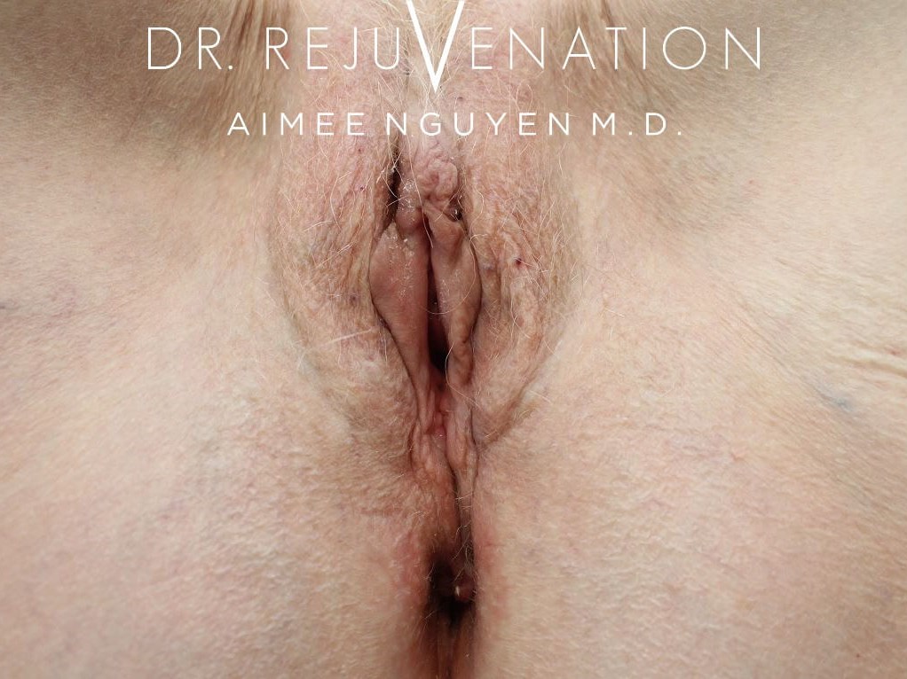 Vaginoplasty Before