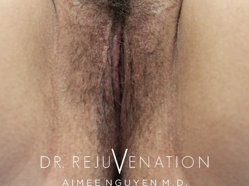 Labiaplasty Minora After