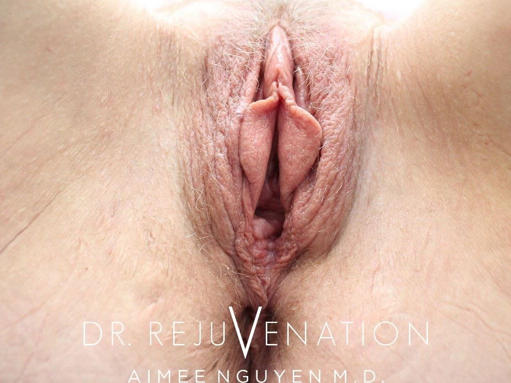 Vaginoplasty Before