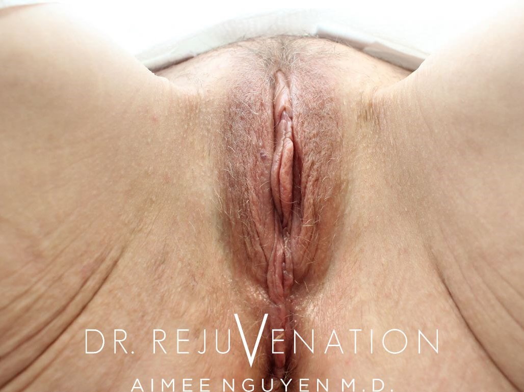 Vaginoplasty After