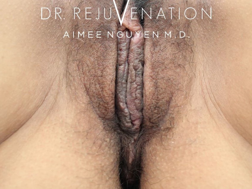 Vaginoplasty, Labiaplasty After