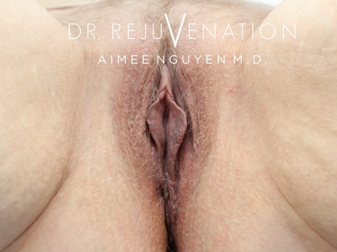 Vaginoplasty After