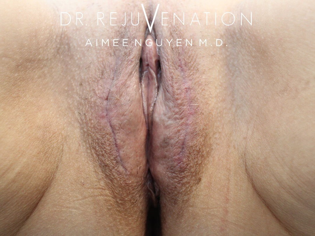 Vaginoplasty, Labiaplasty After